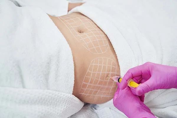 Mesoterapia Corporal